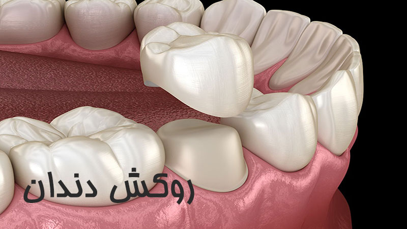 روکش دندان