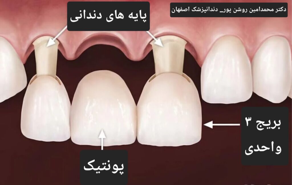 بریج دندانی اصفهان