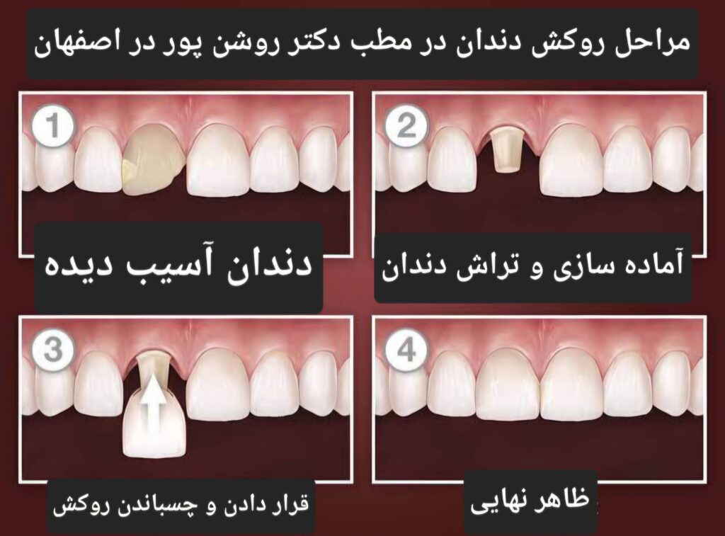 روکش دندان در اصفهان