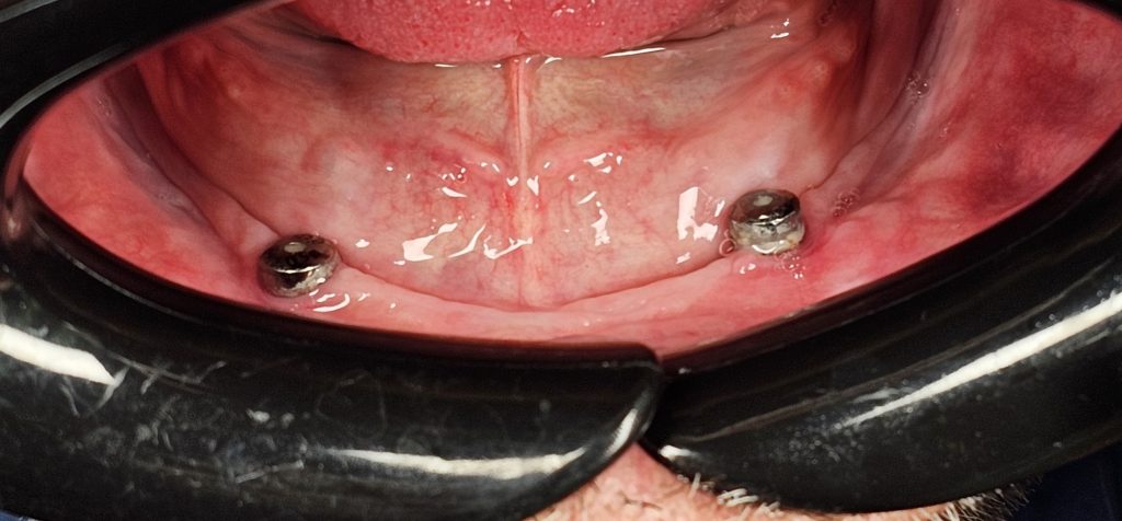 کاشت دو پایه ایمپلنت برای ساخت اوردنچر فک پایین
