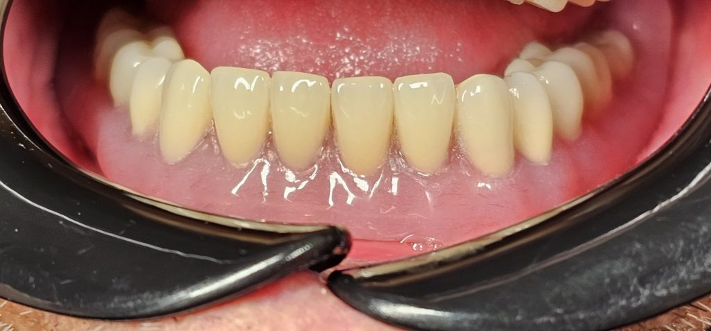 دندان مصنوعی با پایه ایمپلنت فک پایین بر پایه دو ایمپلنت