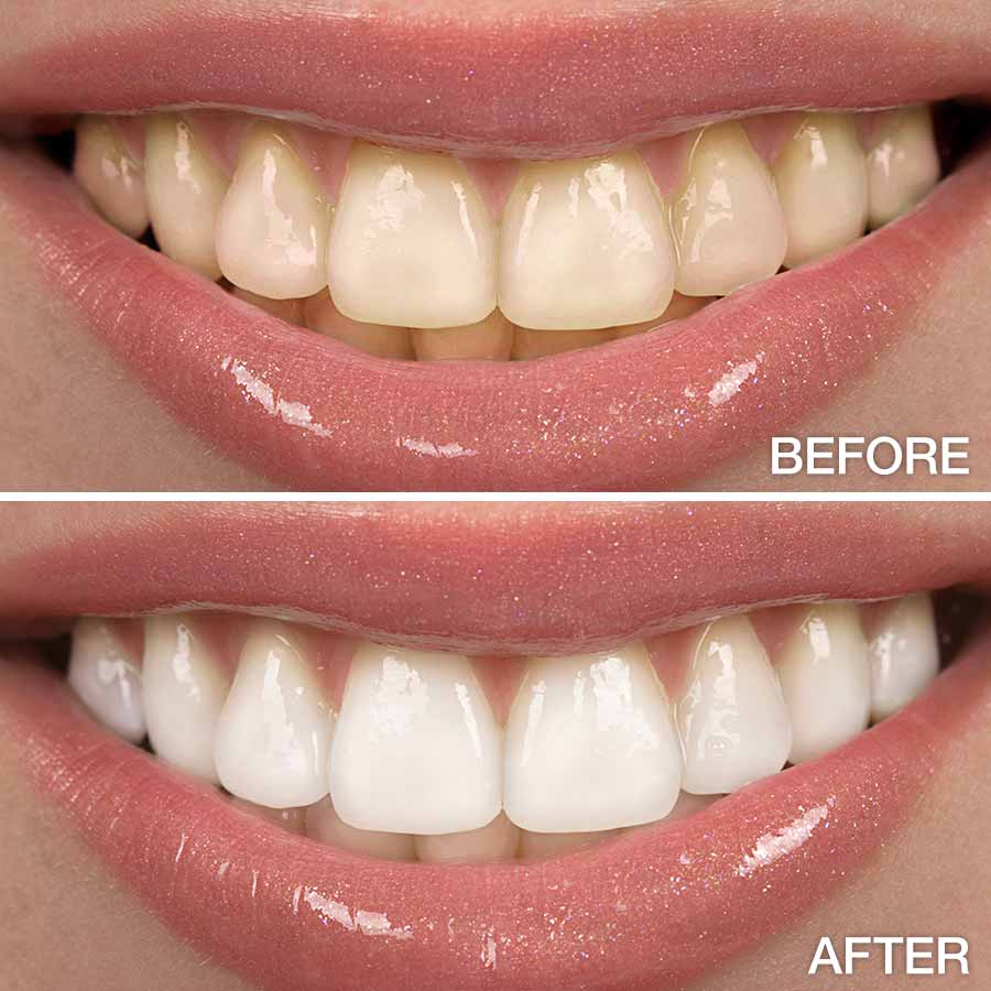 before and after tooth whitening