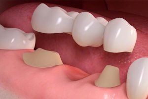 dental-bridges