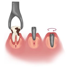 immediate-dental-implant-placement-process