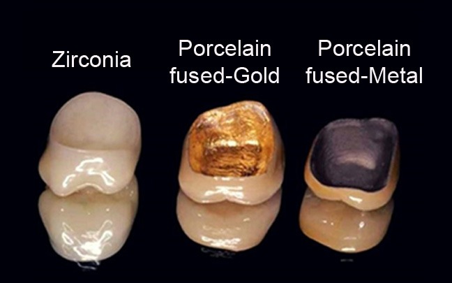 types of crown