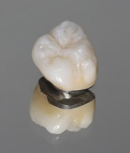 porcelain fuse to metal crown