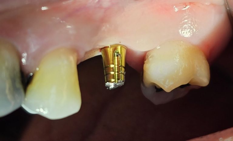 punch implant