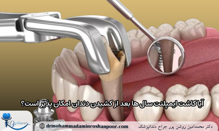 آیا کاشت ایمپلنت سال ها بعد از کشیدن دندان امکان پذیر است؟