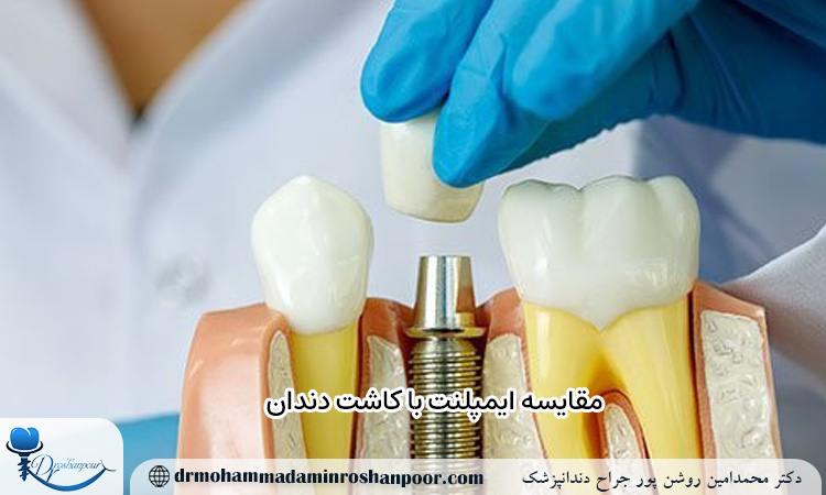 مقایسه ایمپلنت با کاشت دندان