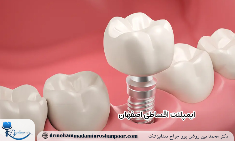 ایمپلنت اقساطی اصفهان