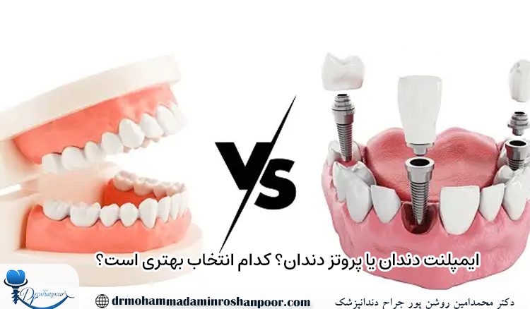 ایمپلنت دندان یا پروتز دندان