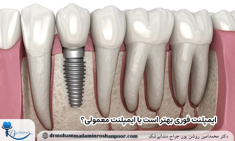 ایمپلنت فوری یا ایمپلنت معمولی