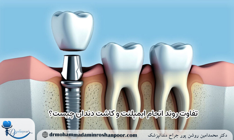 فرق روند انجام ایمپلنت و کاشت دندان