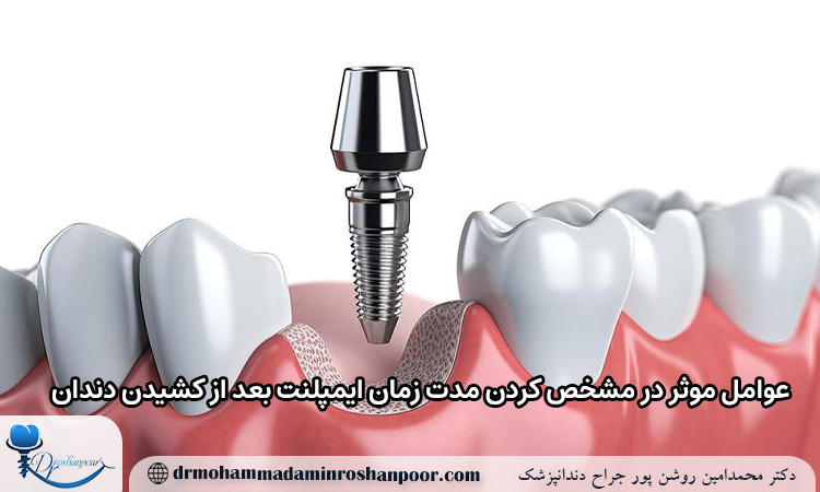 عوامل موثر در مشخص کردن مدت زمان ایمپلنت بعد از کشیدن دندان
