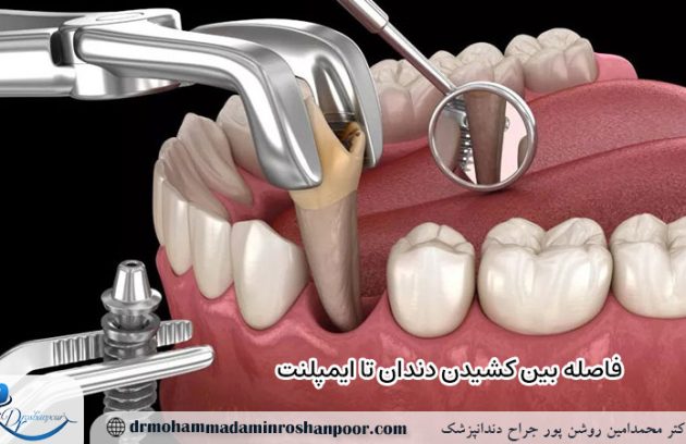 فاصله بین کشیدن دندان تا ایمپلنت