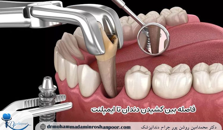 فاصله بین کشیدن دندان تا ایمپلنت
