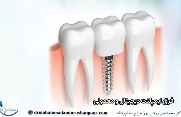 فرق ایمپلنت دیجیتال و معمولی