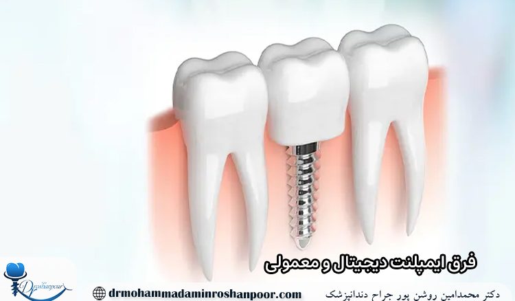 فرق ایمپلنت دیجیتال و معمولی