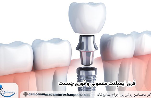 فرق ایمپلنت معمولی و فوری