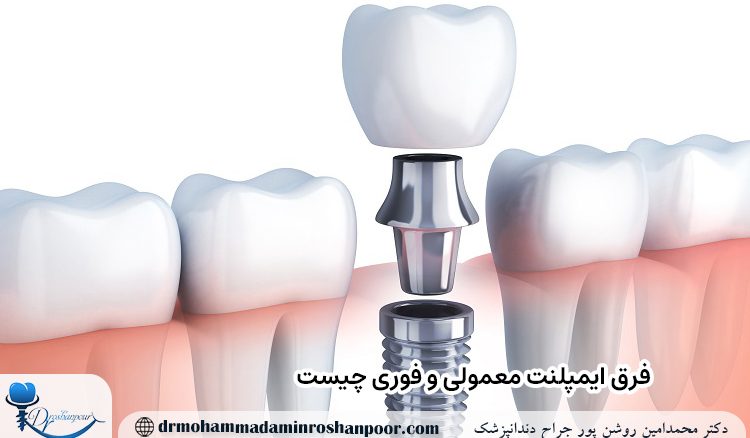 فرق ایمپلنت معمولی و فوری