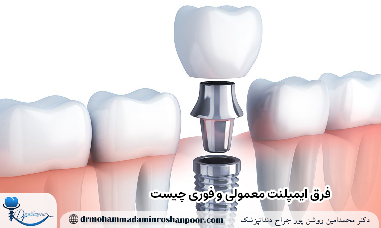 فرق ایمپلنت معمولی و فوری