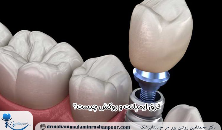 فرق ایمپلنت و روکش