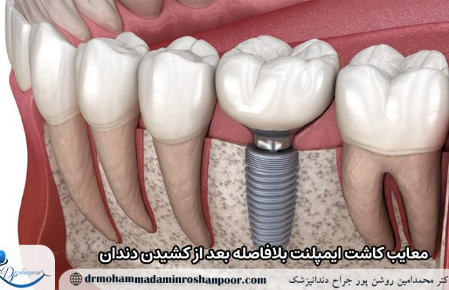 معایب کاشت ایمپلنت بلافاصله بعد از کشیدن دندان