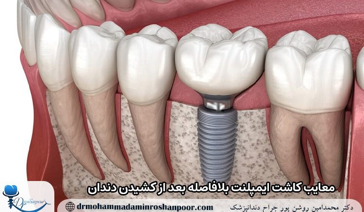 معایب کاشت ایمپلنت بلافاصله بعد از کشیدن دندان