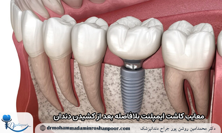 معایب کاشت ایمپلنت بلافاصله بعد از کشیدن دندان