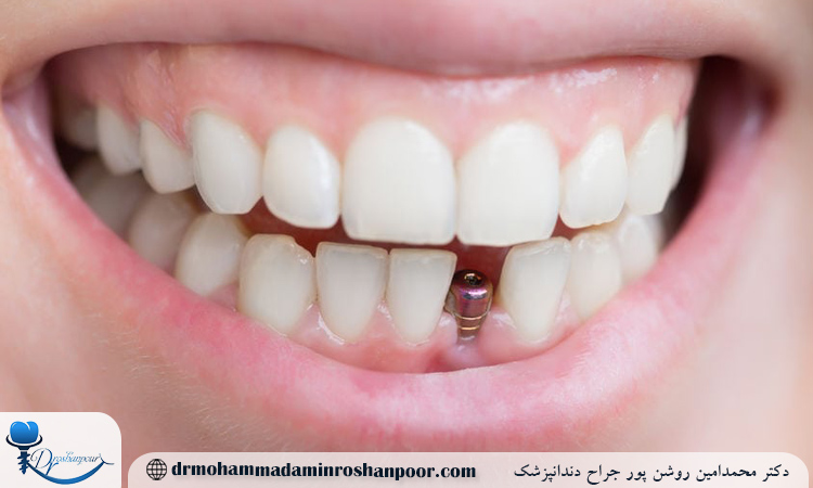 جلوگیری از درد ایمپلنت دندان