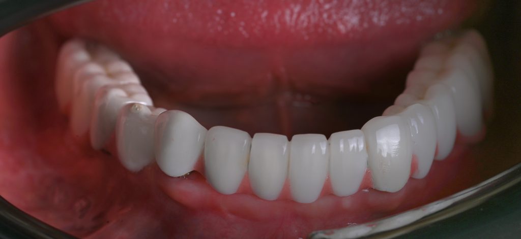 Full mouth mandible implants provide a permanent solution for individuals missing all teeth in the lower jaw (mandible). These implants serve as new tooth roots, and the dental bridge or prosthetic teeth are built on top of them, resembling natural teeth and offering stability and comfort.