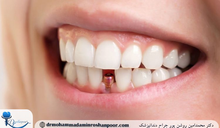 ایمپلنت دندان درد دارد؟