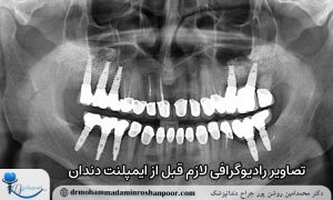 تصاویر رادیوگرافی لازم قبل از ایمپلنت دندان