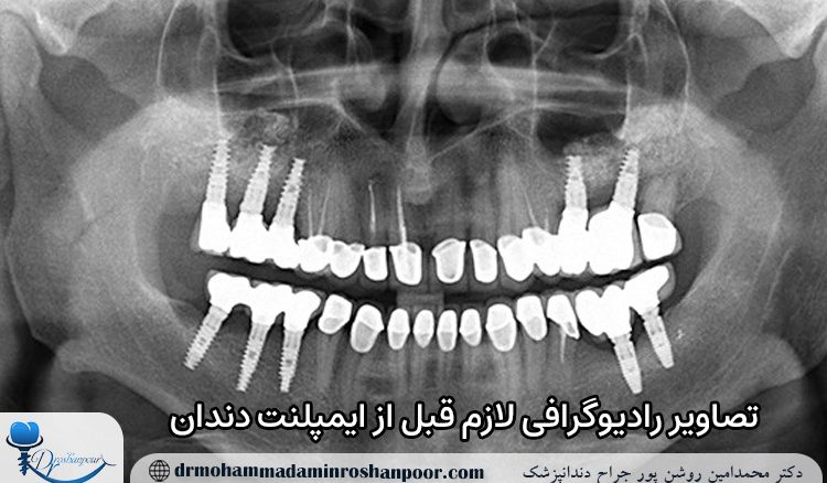 تصاویر رادیوگرافی لازم قبل از ایمپلنت دندان