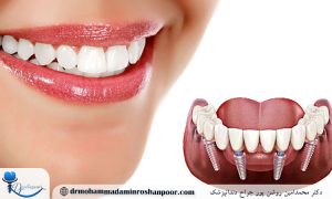 قالب‌ گیری ایمپلنت چیست و چند مرحله دارد