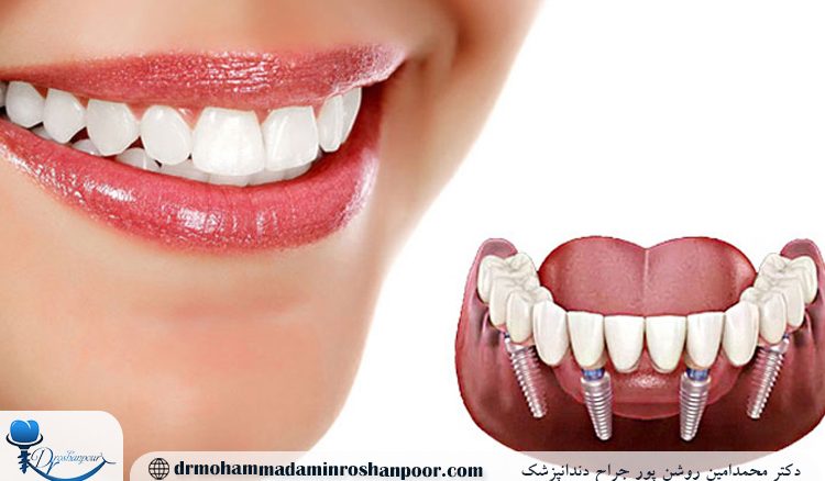 قالب‌ گیری ایمپلنت چیست و چند مرحله دارد