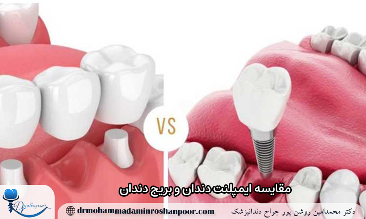 مقایسه ایمپلنت دندان و بریج دندان