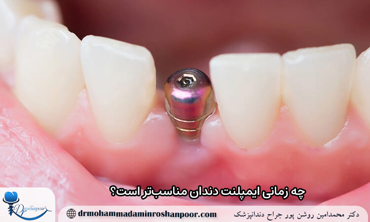 چه زمانی بریج دندان مناسبتر است؟