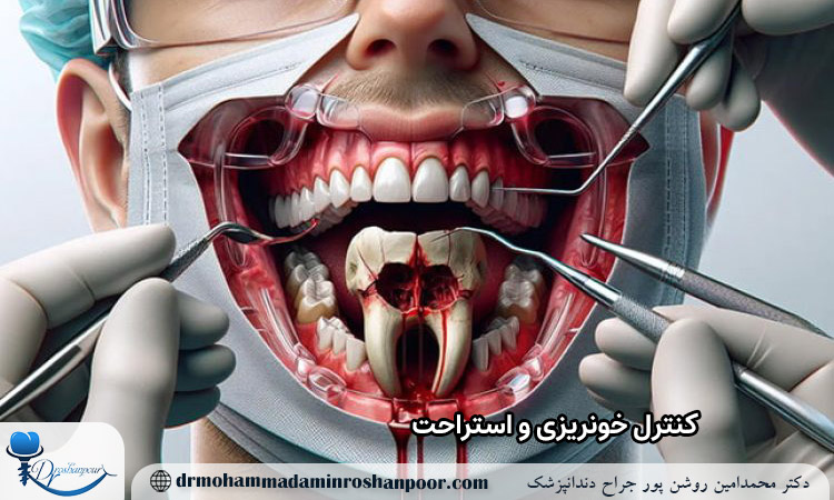 کنترل خونریزی و استراحت