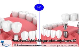 تفاوت بین ایمپلنت دندان و بریج دندان: کدام مناسب‌ تر است؟