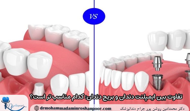 تفاوت بین ایمپلنت دندان و بریج دندان: کدام مناسب‌ تر است؟