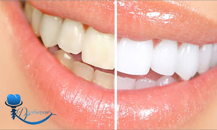 تکنیک‌های مدرن سفید کردن دندان