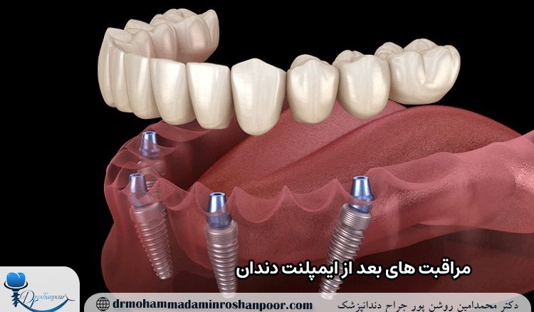 مراقبت‌ های بعد از ایمپلنت دندان