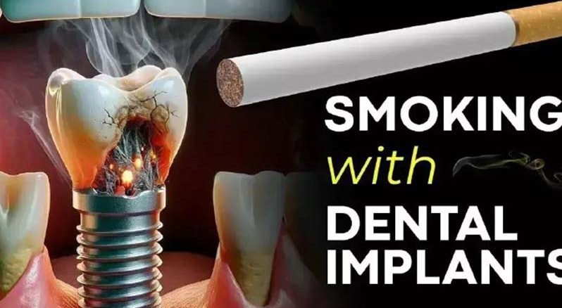 ایمپلنت-افراد-سیگاری