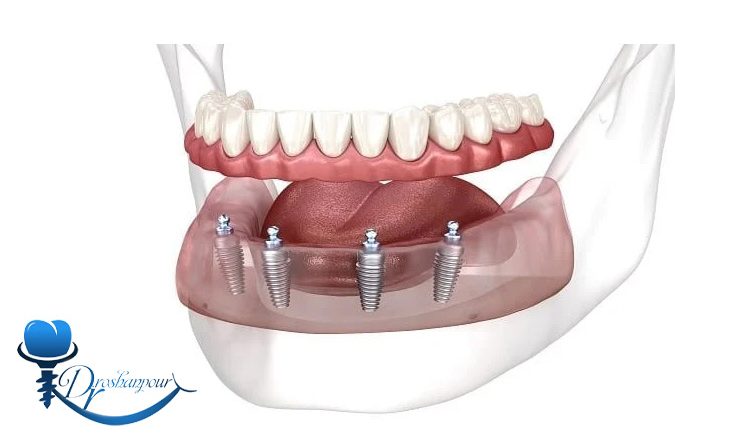 ایمپلنت در فک بالا و فک پایین چه تفاوت‌ هایی دارد؟