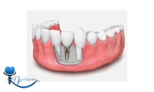 آیا ایمپلنت دندان برای افرادی که استخوان فک ضعیف دارند مناسب است؟