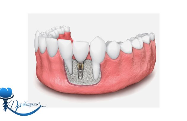 آیا ایمپلنت دندان برای افرادی که استخوان فک ضعیف دارند مناسب است؟