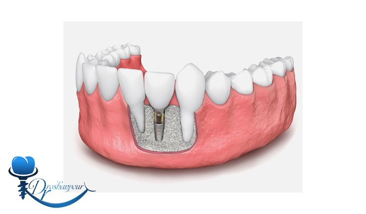 آیا ایمپلنت دندان برای افرادی که استخوان فک ضعیف دارند مناسب است؟