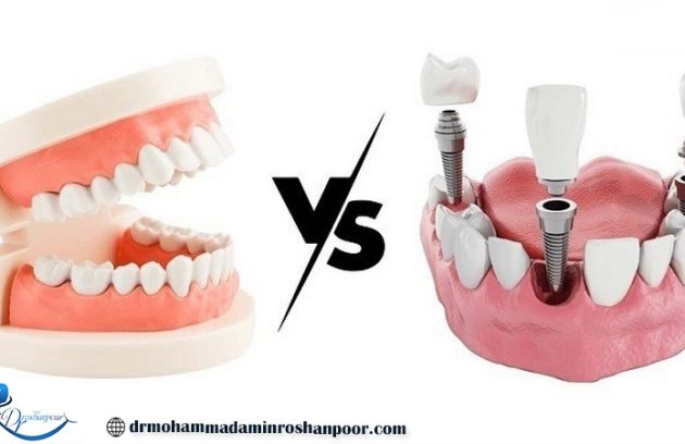 مقایسه ایمپلنت دندان و دندان مصنوعی
