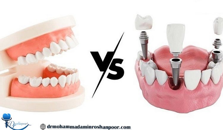 مقایسه ایمپلنت دندان و دندان مصنوعی